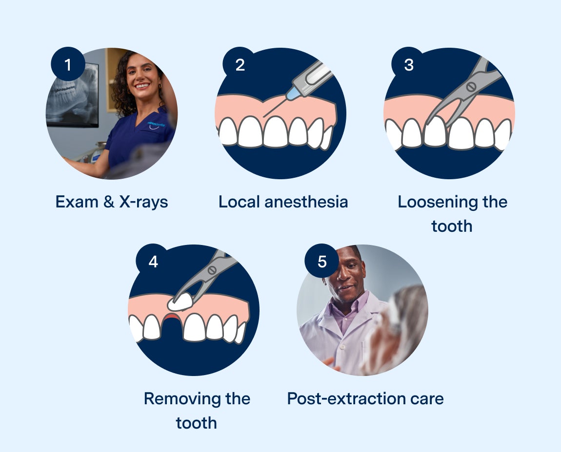 Aspen Dental illustration showing the five steps of a tooth extraction process: Exam & X-rays, local anesthesia, loosening the tooth, removing the tooth, and post-extraction care. The steps are depicted with icons of a dentist, dental tools, and teeth.