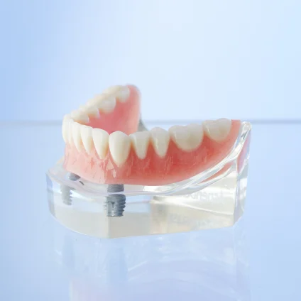Aspen Dental implant-supported dentures. 