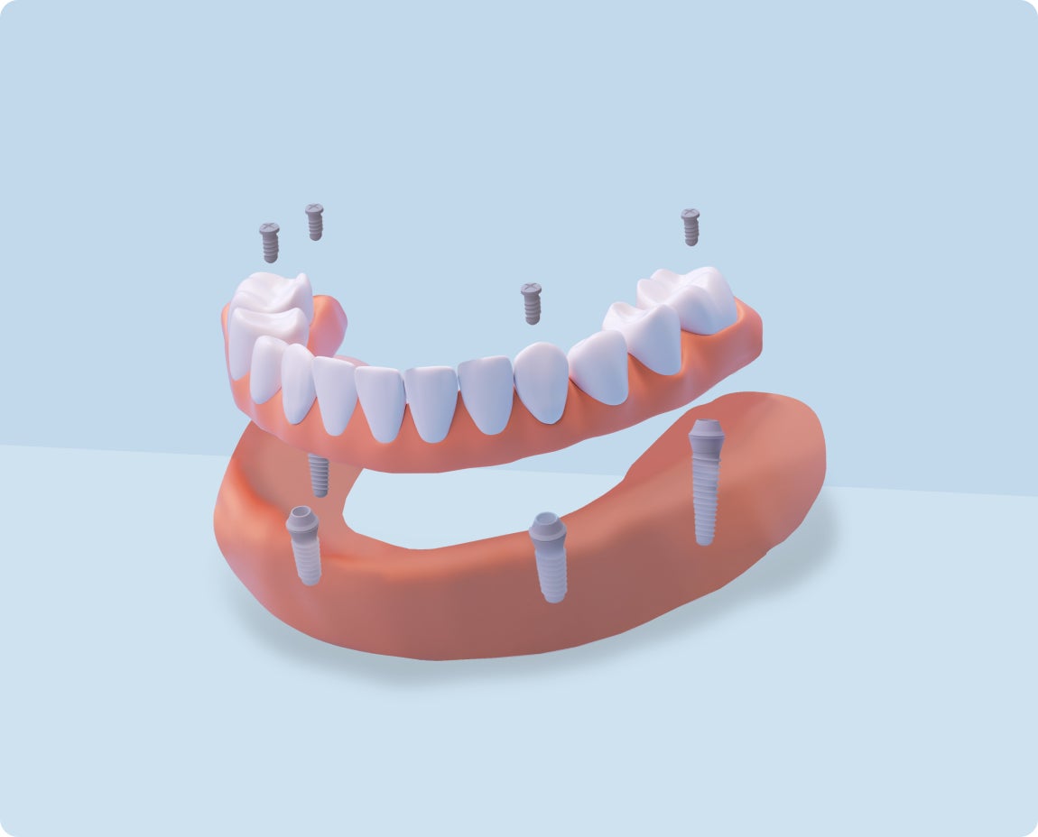3D model showing a full-mouth dental implant setup with upper and lower prosthetic arches secured by implants, illustrating ClearChoice’s approach to complete tooth replacement solutions.
