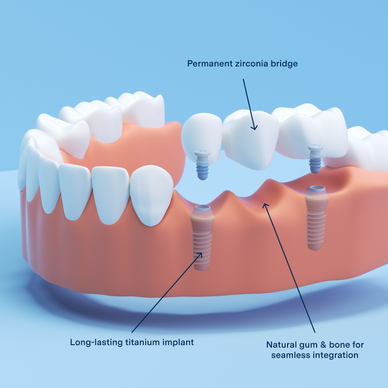 Aspen Dental implant bridge 3D rendering. 