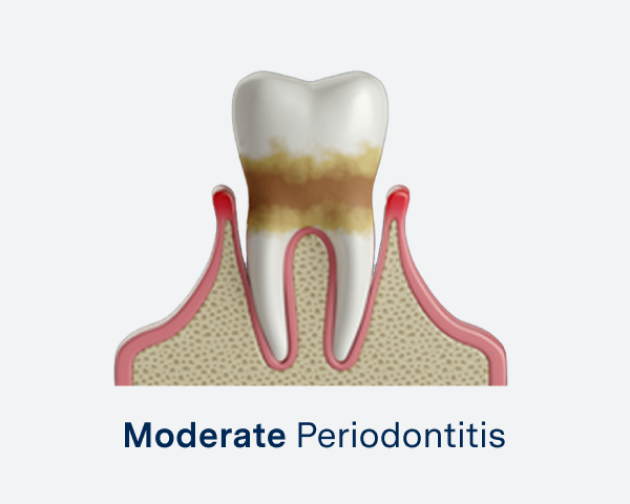Illustration of a tooth with moderate periodontitis, showing gum inflammation, gum recession, and bone loss around the tooth.