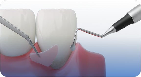 A close-up look into a teeth model where bone graft procedure is being performed with a probe and a tweezer for the bone tissue transplant.
