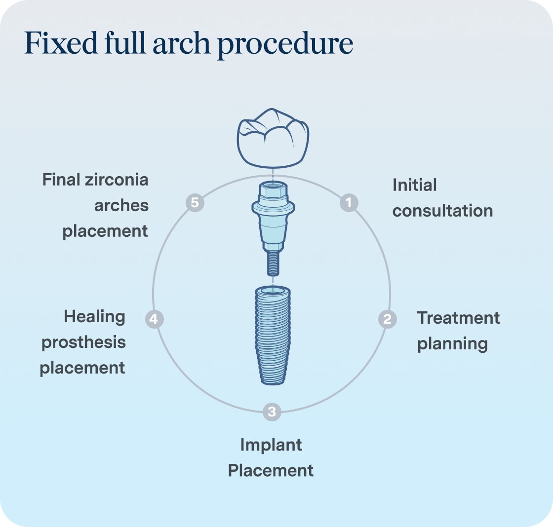 A diagram illustrating the steps involved in a fixed full arch dental implant procedure, with finalized zirconia arches being placed as the last step.