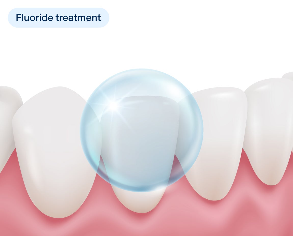  Illustration of a fluoride treatment application on teeth, showing a protective bubble over a white tooth and healthy gums, labeled with "Fluoride treatment" in a dental care context.