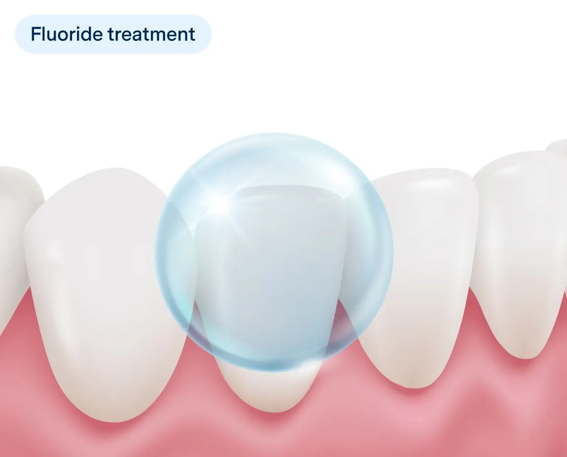 Illustration of a fluoride treatment application on teeth, showing a protective bubble over a white tooth and healthy gums, labeled with "Fluoride treatment" in a dental care context.