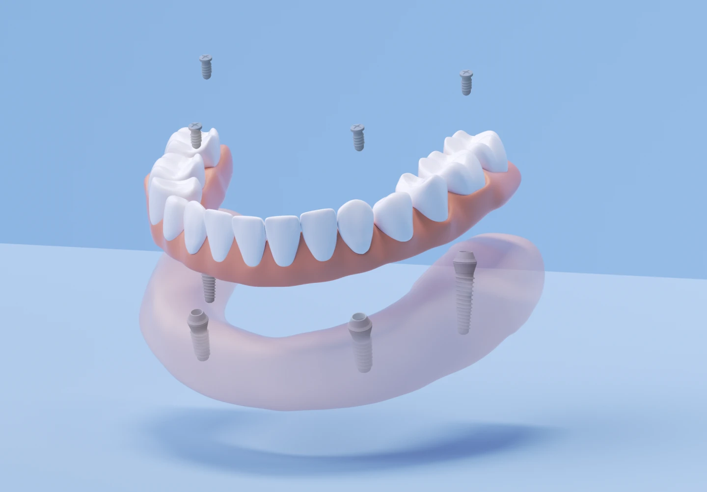 Aspen Dental All on 4 dental implants. 