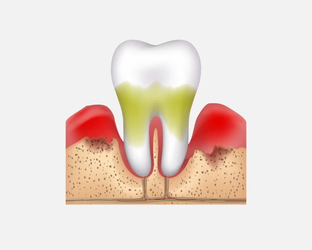 an image of tooth and gums infected an advance stage of periodontitis.
