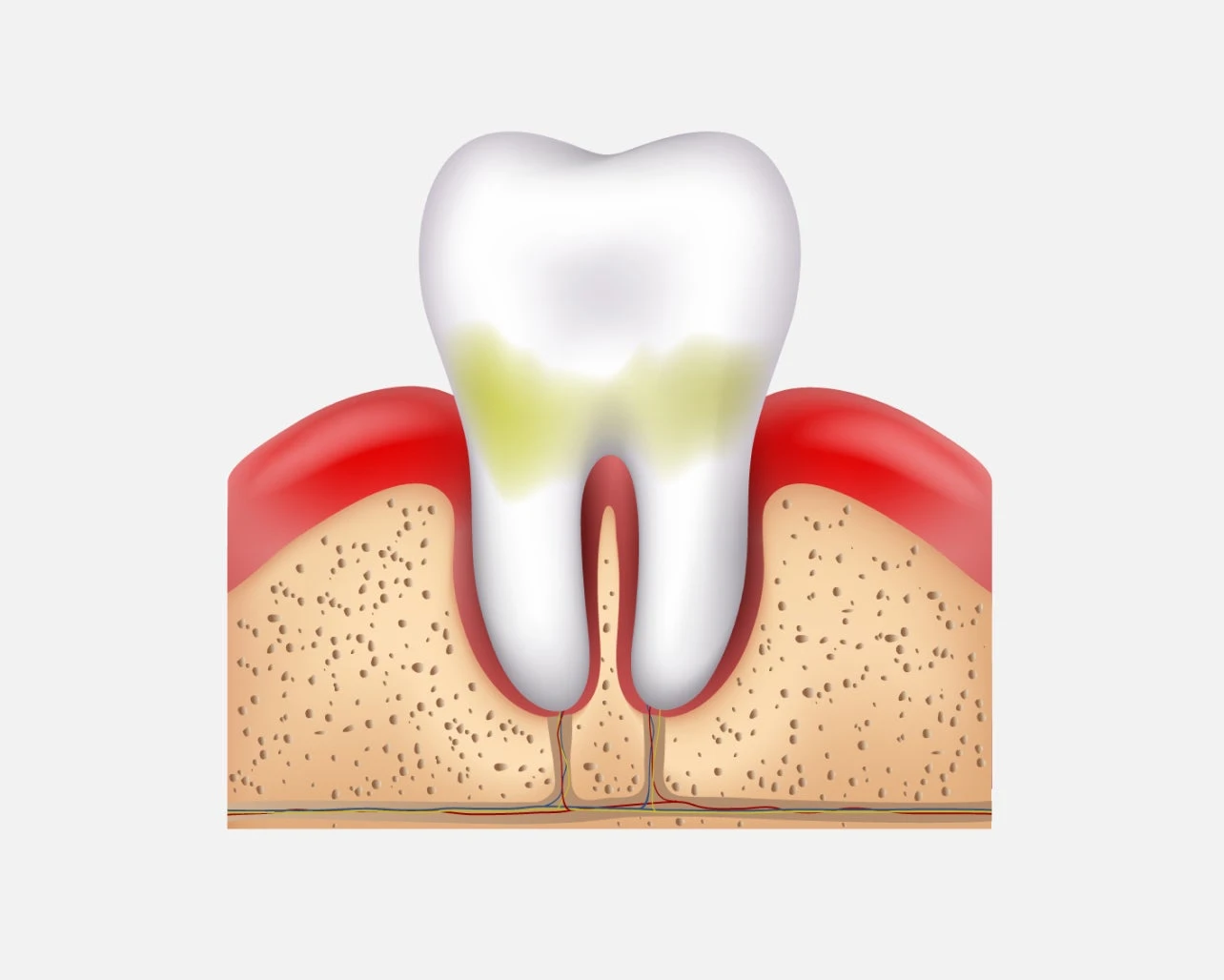 an image of tooth and gums infected with gingivitis.