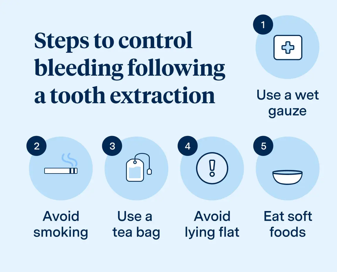  Infographic listing steps to control bleeding following a tooth extraction, including using wet gauze, avoiding smoking, using a tea bag, avoiding lying flat, and eating soft foods, provided by Aspen Dental.
