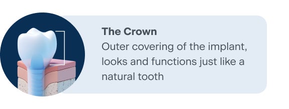 Illustration of a dental implant crown showing the outer covering that resembles and functions like a natural tooth for ClearChoice.