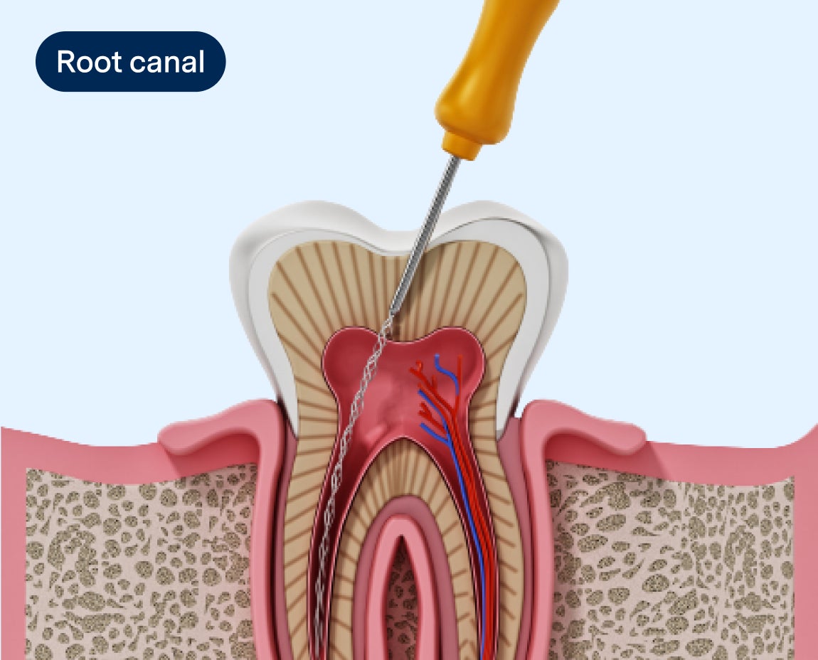 A detailed illustration of a root canal procedure, showing the removal of infected tissue inside the tooth, representing the professional and precise root canal treatments offered by Aspen Dental.