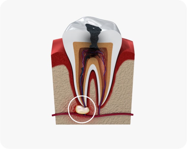 Cross-section diagram of a tooth showing decay reaching the pulp, with a circled dental abscess at the root tip surrounded by red inflamed tissue indicating infection.