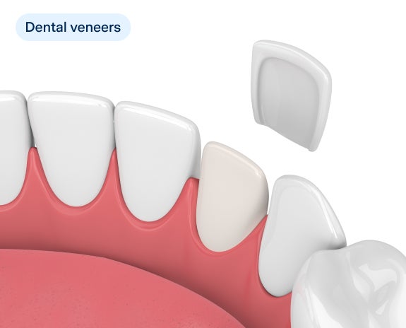 Illustration showing the application of a dental veneer on a tooth, highlighting how veneers are thin shells of porcelain or composite resin used to cover the front surface of teeth for cosmetic improvement.