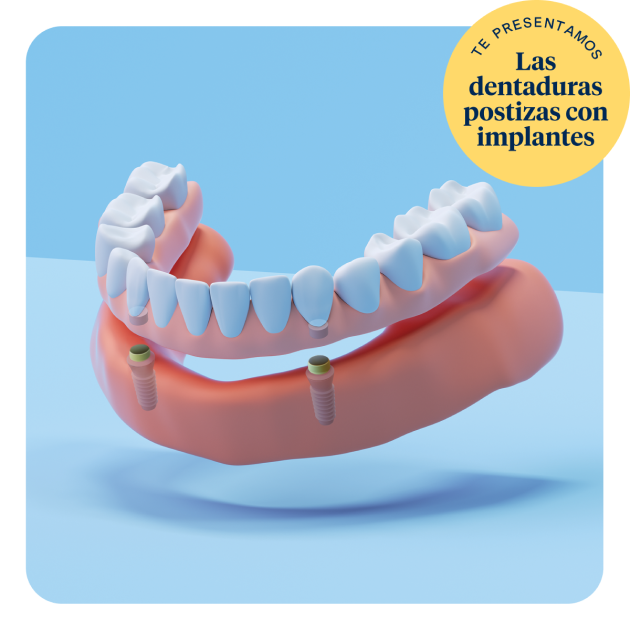 Un gráfico que muestra la fila inferior de dentaduras postizas con implantes sobre un fondo azul claro, con un subtítulo al lado que dice "Las dentaduras postizas con implantes"