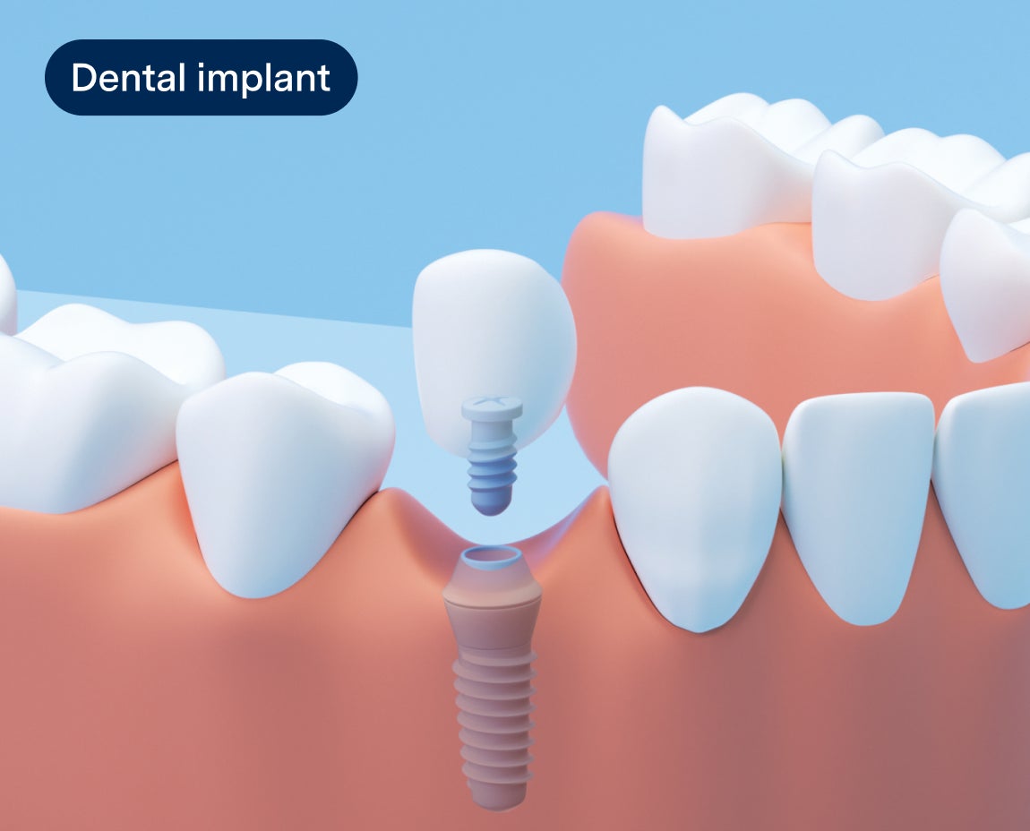 3D illustration of a dental implant showing the placement process, including the titanium post and crown, representing advanced tooth replacement solutions at Aspen Dental.