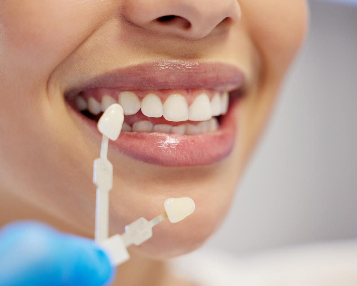 A woman smiling while a dental professional holds a shade guide next to their teeth for color matching, ensuring the perfect fit for their new dental veneers.