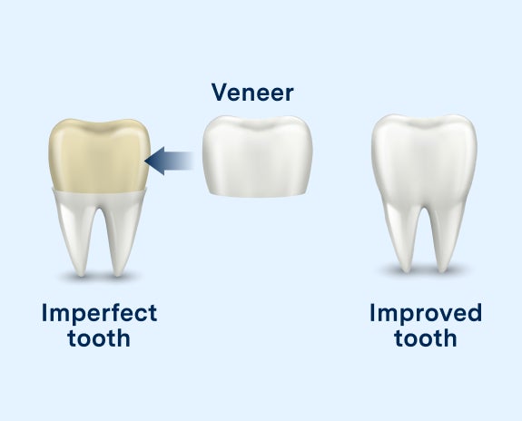 Illustration showing the application of a veneer to transform an imperfect tooth into an improved tooth, highlighting the cosmetic benefits of veneers.
