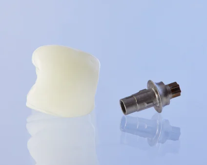 An Aspen Dental single tooth implant. 