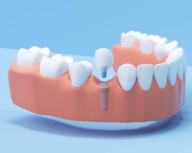 Dental Implant Types