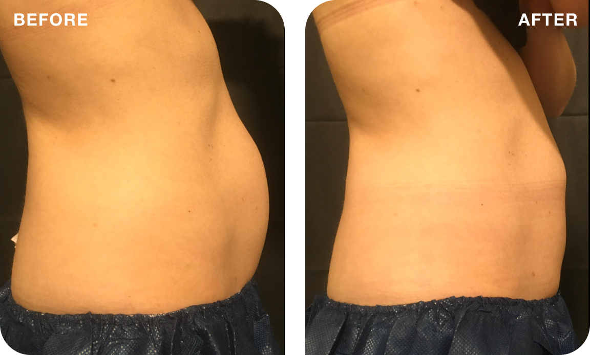 A side-by-side before-and-after image showing a person’s midsection in profile, with the “before” image showing a more rounded abdomen and the “after” image showing a flatter, more contoured waistline, both photographed against a neutral background.