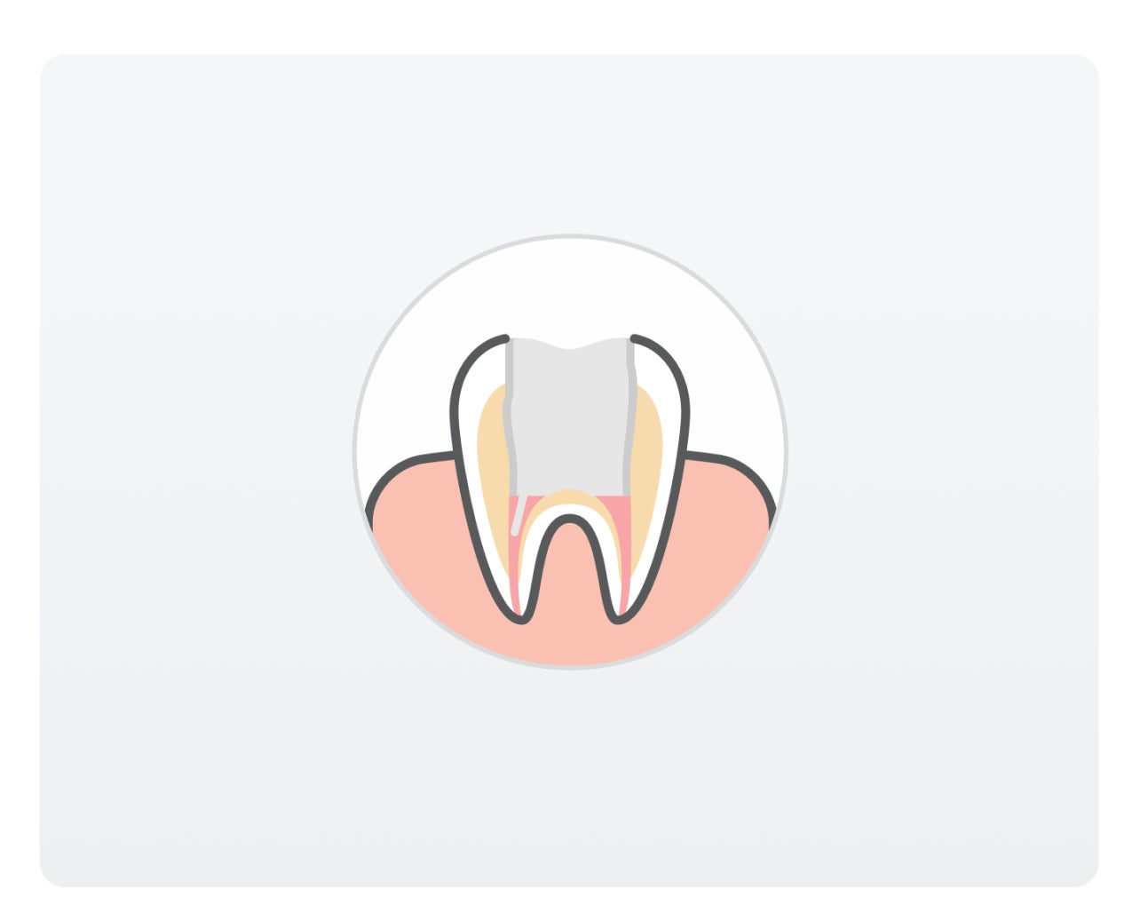  Illustration of a tooth showing an hollow opening in the tooth crown with a light grey background.