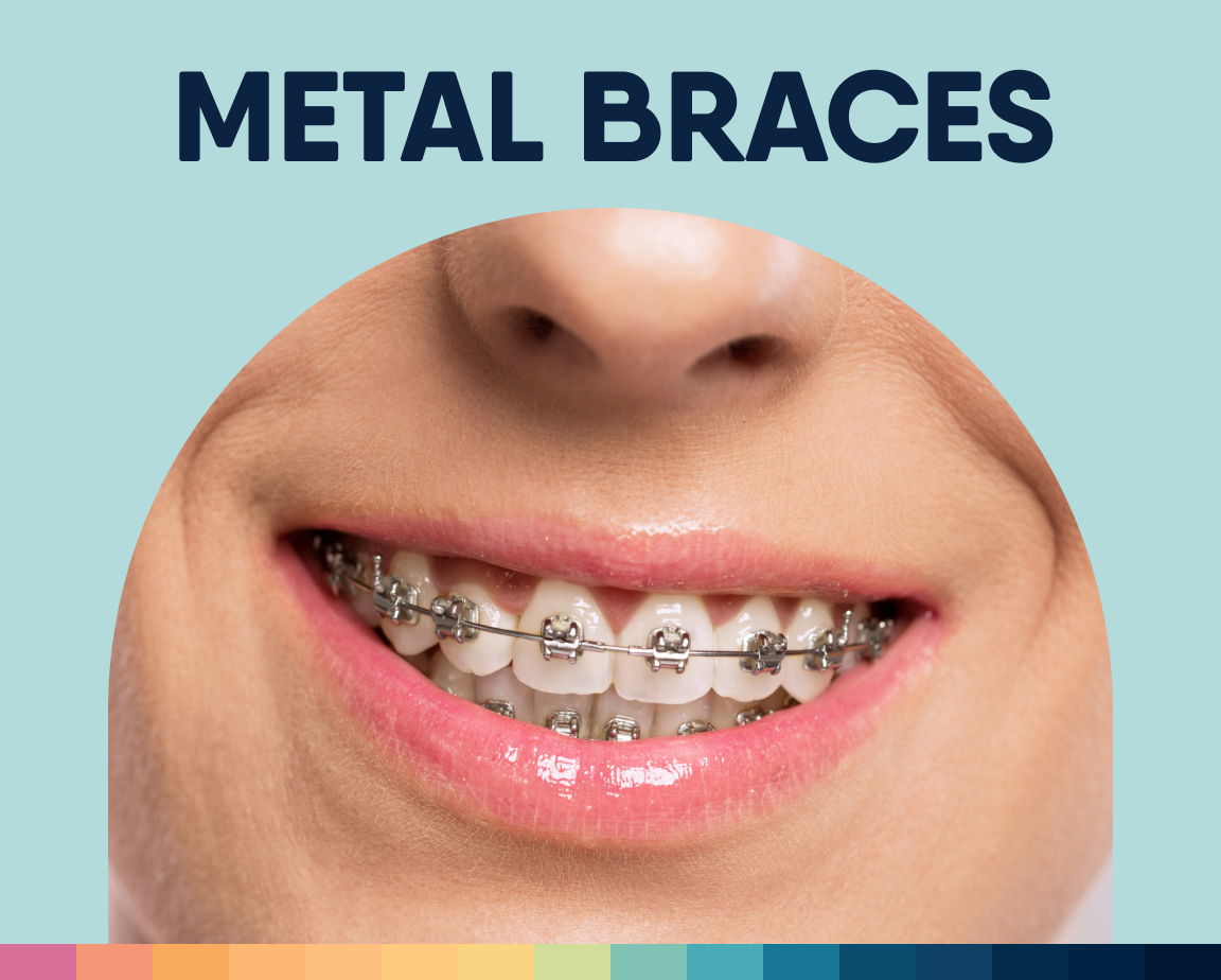 Smiling mouth with metal braces, text METAL BRACES above.