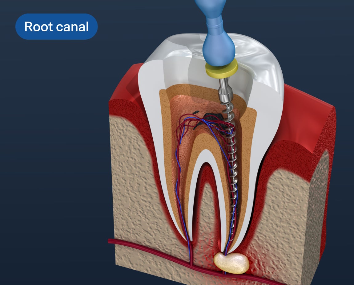 A detailed 3D illustration of a root canal procedure showing the internal structure of a tooth and the dental tool removing infected pulp, representing expert endodontic care at Aspen Dental.