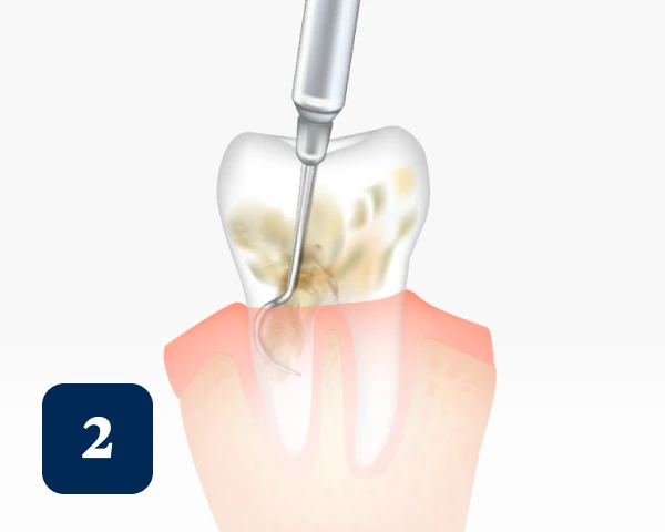 Illustration of a dental procedure root planing showing a dental tool cleaning the roots of a tooth. The image is labeled with the number "2" in a blue square.