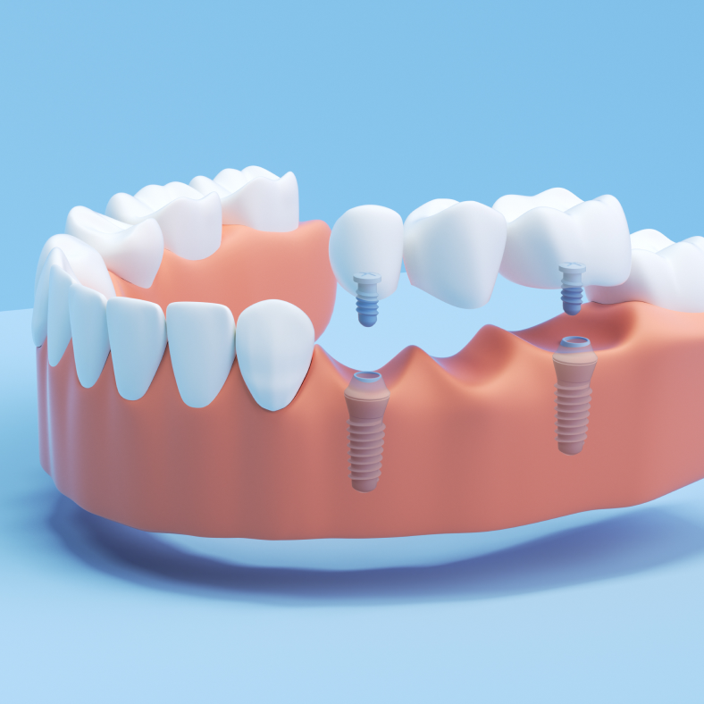 Aspen Dental implant bridge renderings. 
