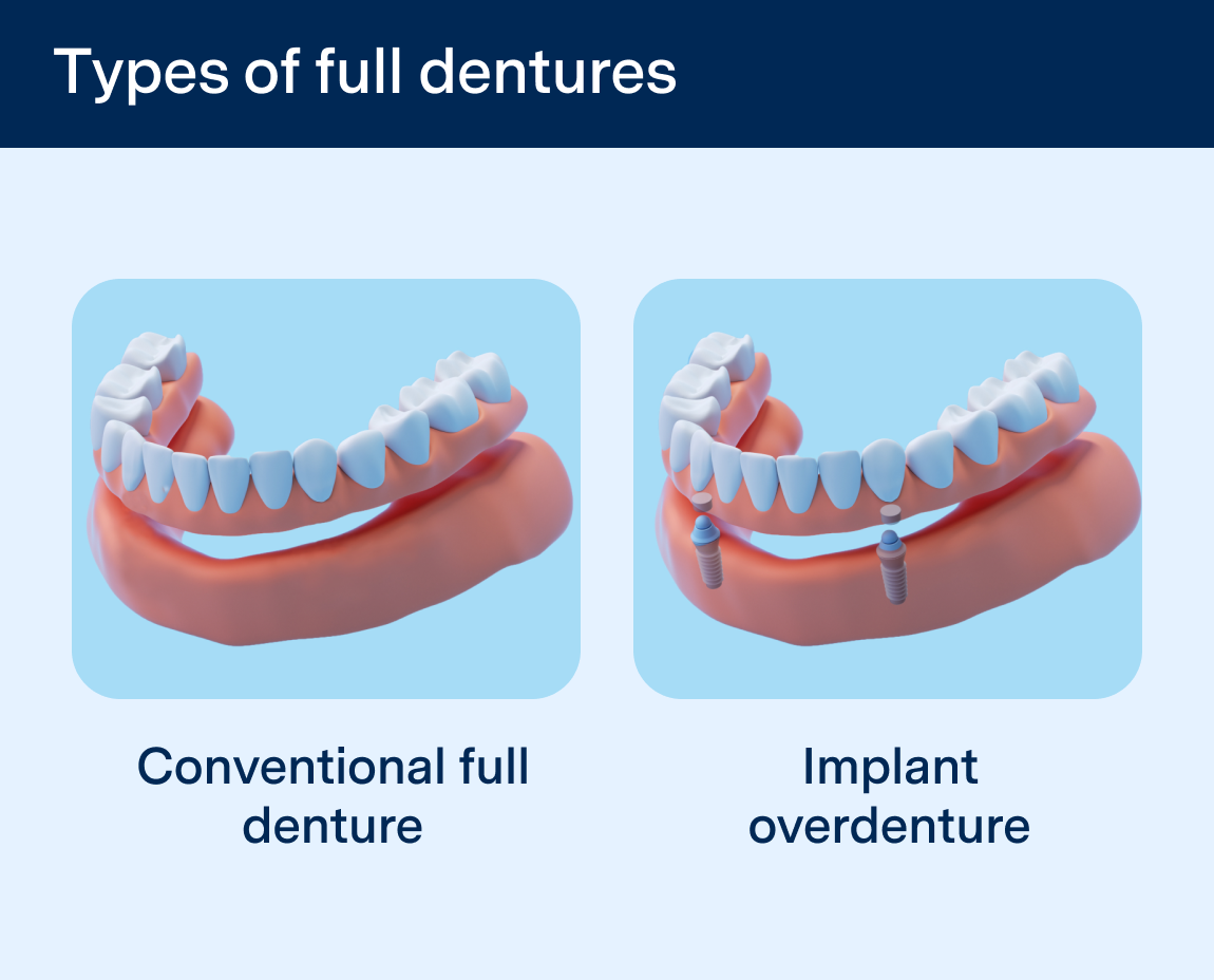 A graphic with the words 'Types of dentures' that shows a comparison of between conventional full dentures and full denture implants on a light blue background.