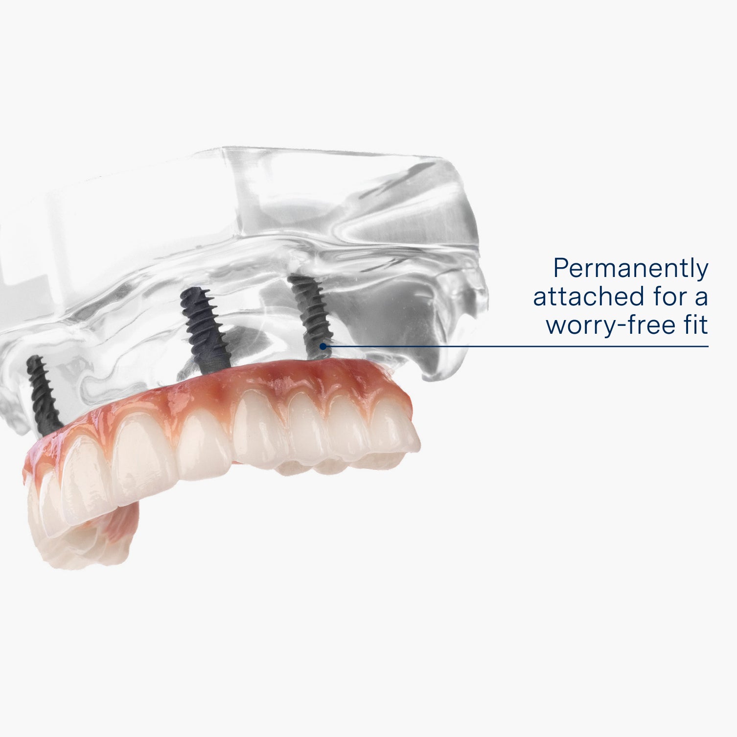 A dental implant model demonstrating a permanently attached full-arch restoration for a secure, worry-free fit. Designed for stability and long-term durability, this implant solution provides a natural-looking smile.
