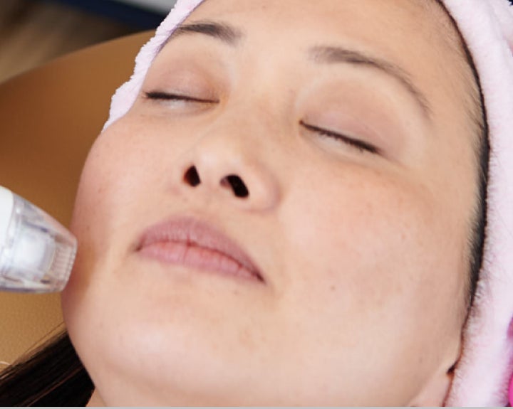 A close up of a woman 's face with her eyes closed during VirtueRf microneedling.