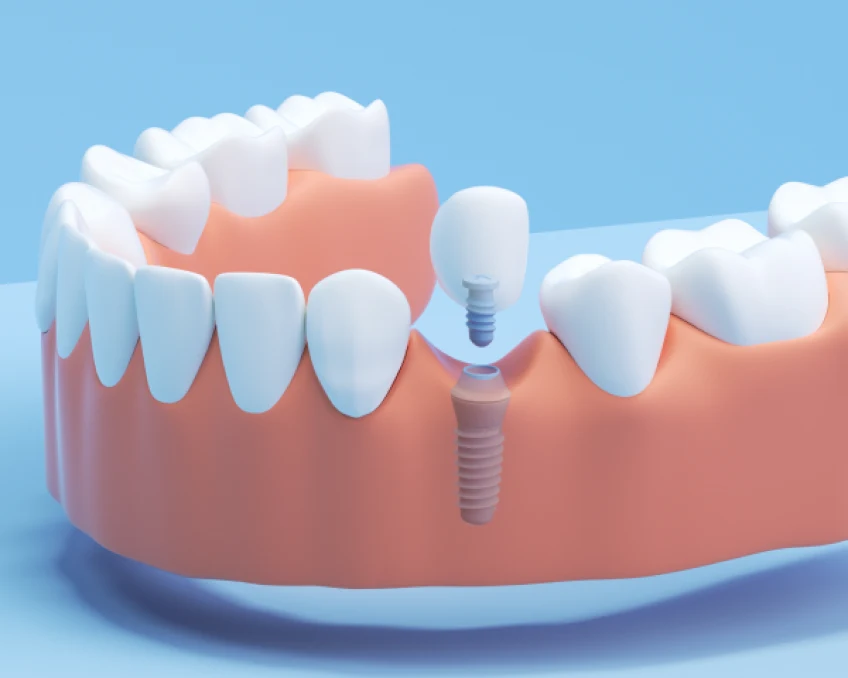 An illustration of a single tooth dental implant showcasing a tooth and an implant as a permanent solution for missing teeth.