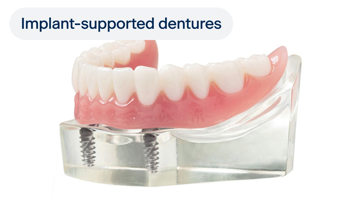 A lower arch implant-supported denture model with two implants, with a label indicating "implant-supported dentures" on the top left corner.