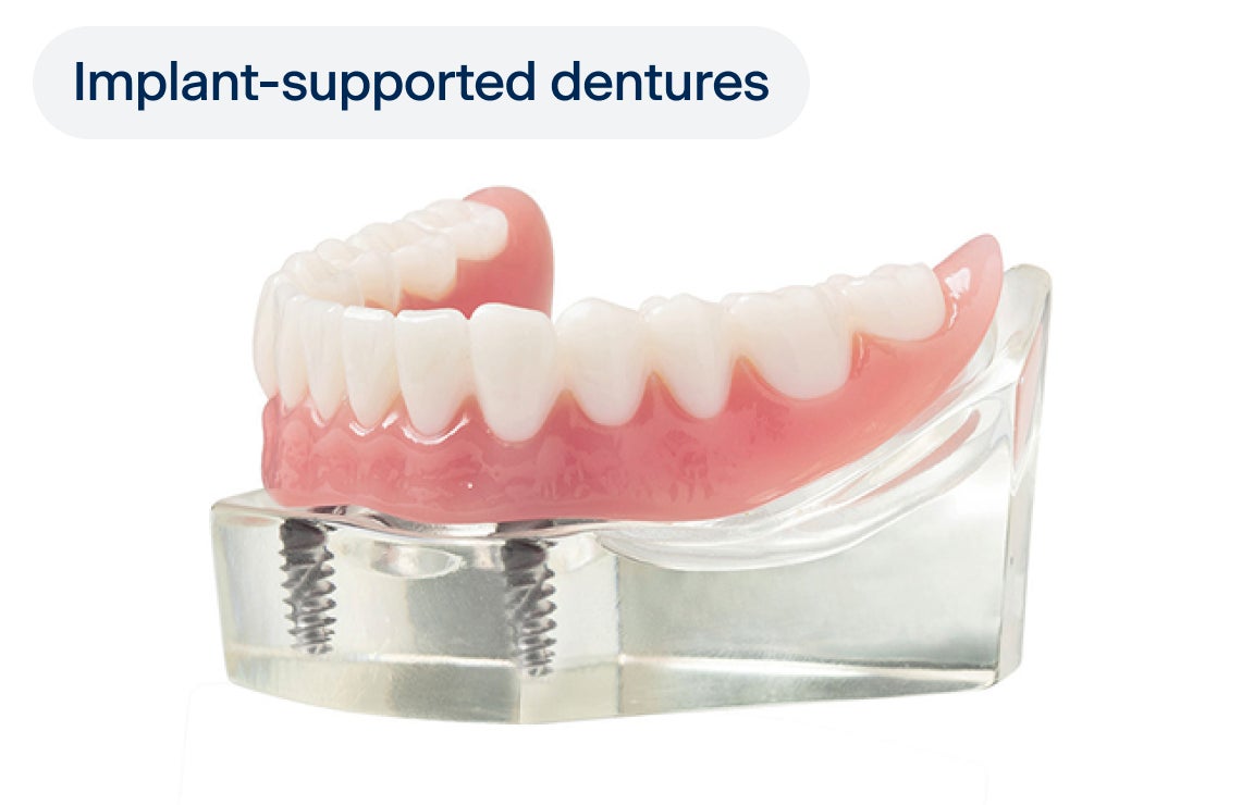 A lower arch implant-supported denture model with two implants, with a label indicating "implant-supported dentures" on the top left corner.