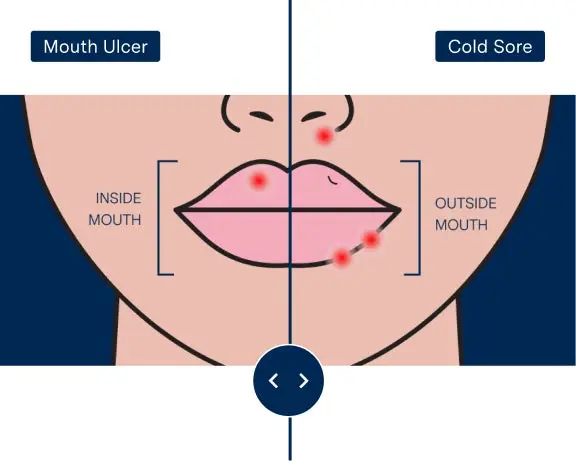 An illustration showing different types and locations of mouth ulcers, highlighting multiple ulcers on the inner mouth and a single ulcer on one side. The diagram visually differentiates ulcer placement inside and outside the mouth for educational purposes.