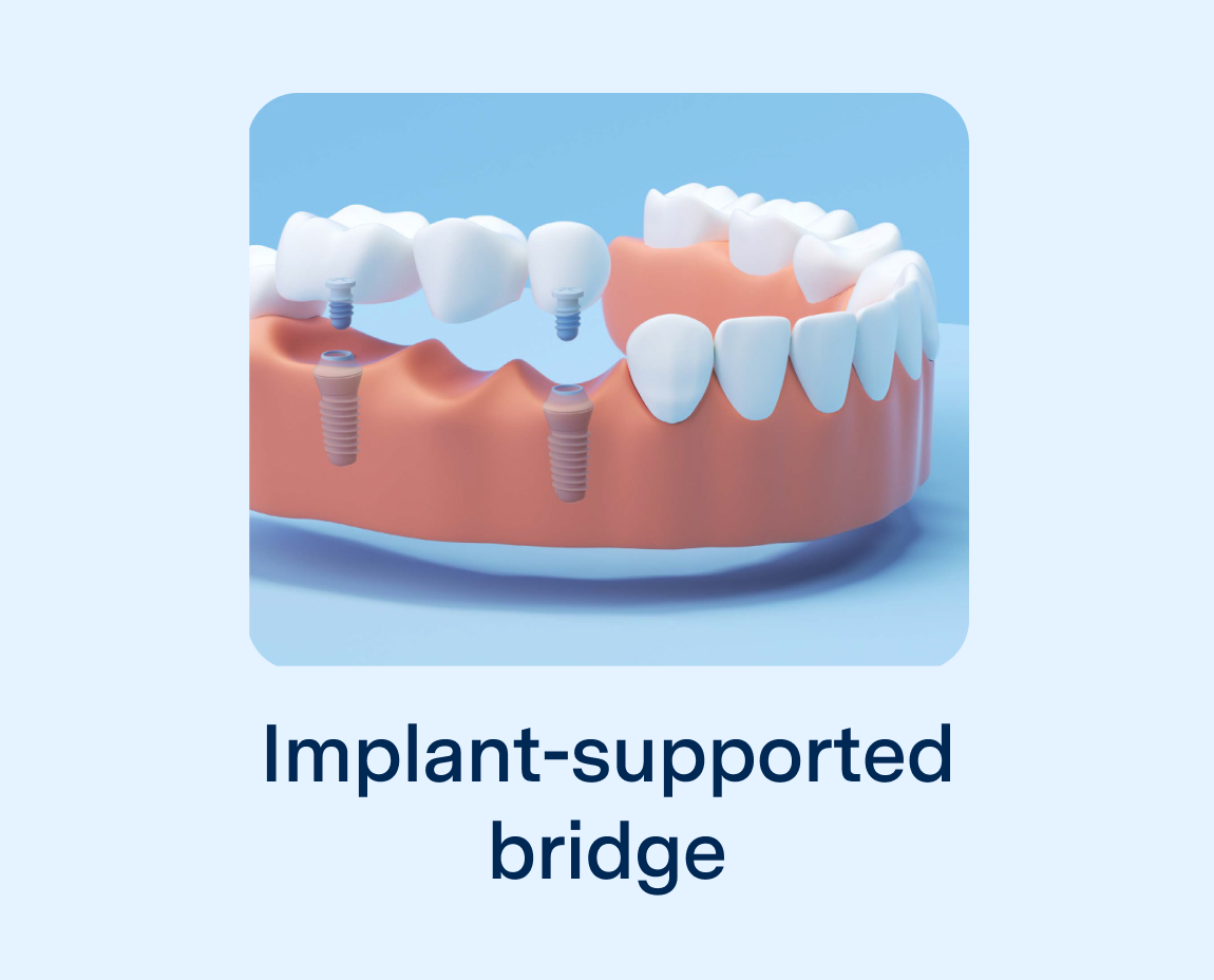 Implant-supported bridge with dental implants, providing a stable and natural-looking solution for missing teeth.
