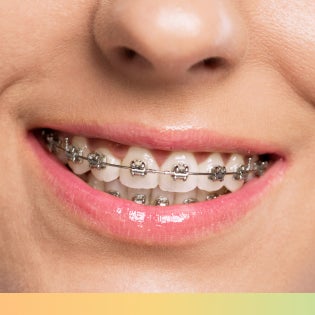 Close-up of traditional metal braces, showcasing a durable and effective orthodontic treatment option.