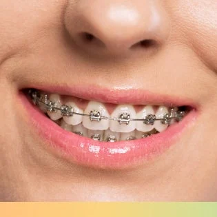 Close-up of traditional metal braces, showcasing a durable and effective orthodontic treatment option.