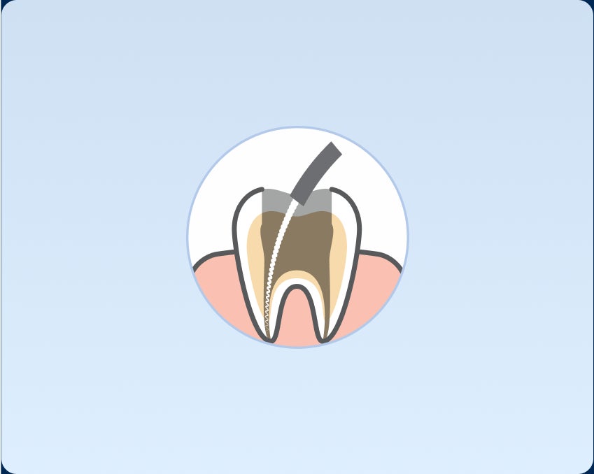  Illustration of a tooth cross-section showing a root canal procedure being performed with a dental file inside the root canal.