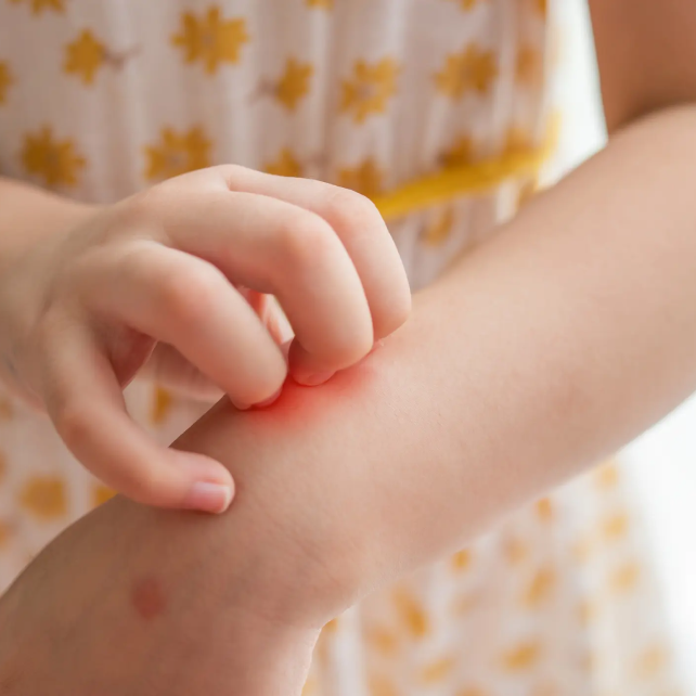 A child scratches Hives on their arm. 