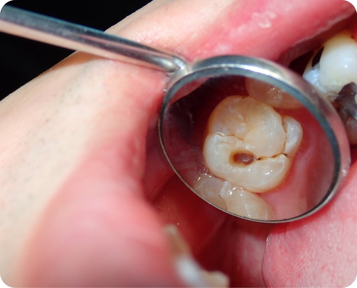 A close-up of a decayed molar with a visible cavity, shown using a dental mirror during examination.