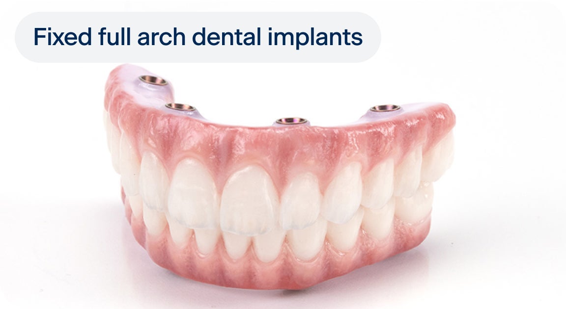 An image of a pair of upper and lower arch dental implant models, with four implants each, and a label indicating "fixed full arch dental implants" on the top left corner of the image.