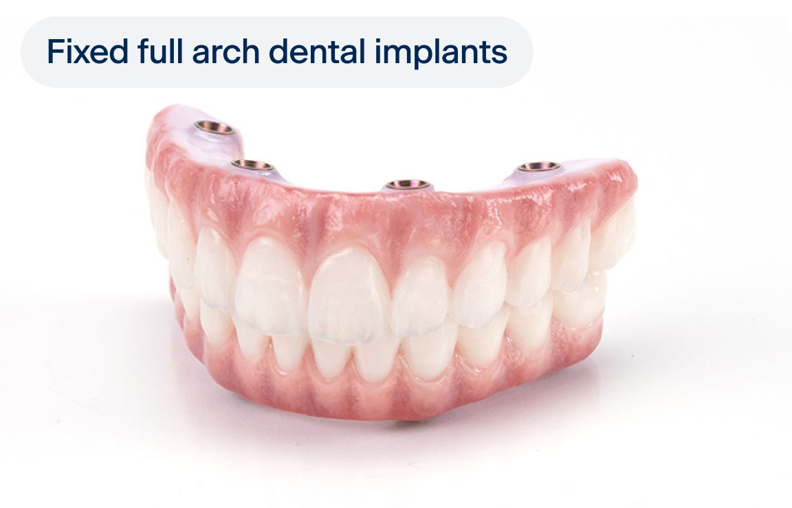 An image of a pair of upper and lower arch dental implant models, with four implants each, and a label indicating "fixed full arch dental implants" on the top left corner of the image.