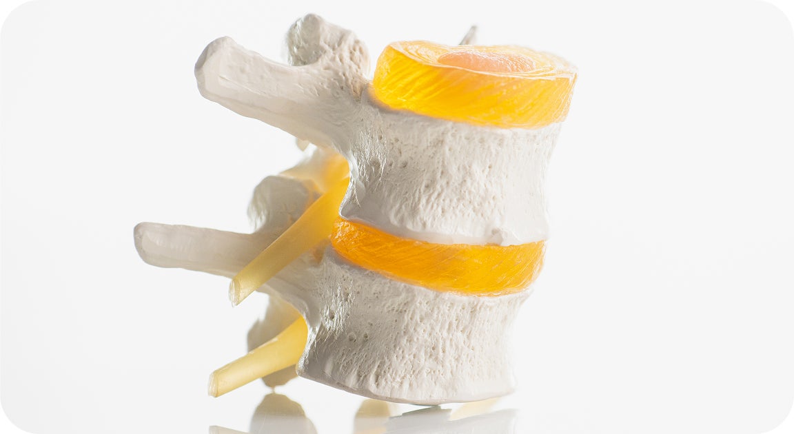 A model of two vertebrae with orange intervertebral discs and yellow nerve roots, illustrating how osteoporosis can weaken bone density and affect dental implant surgery eligibility.