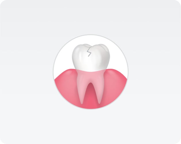 Illustration of a cracked and chipped tooth embedded in gum tissue, displayed in a circular frame.