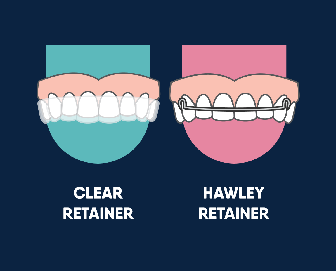 Why Do You Need a Retainer After Braces? | Motto Aligners