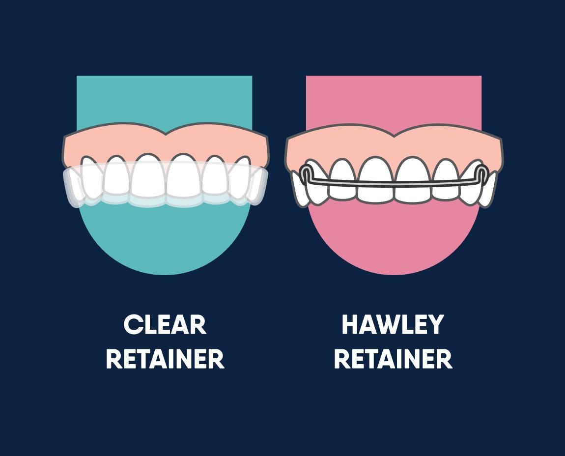 Graphic showing two types of dental retainers. On the left, a clear retainer fitted over teeth and labeled "CLEAR RETAINER". On the right, a Hawley retainer featuring a metal wire and acrylic base, with a pink background and labeled "HAWLEY RETAINER".