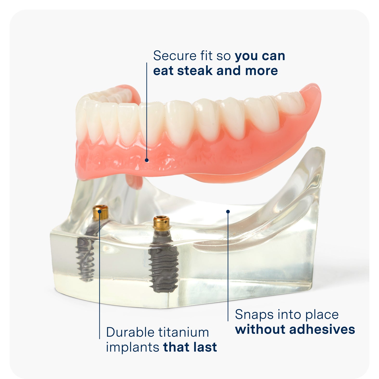 Aspen Dental implant denture model showing secure fit without adhesive and titanium implants for long-lasting support.
