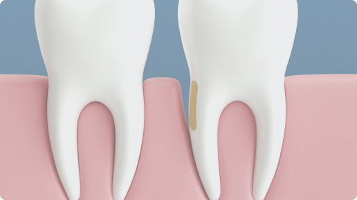 A 3D graphic representation of treating Periodontal Disease